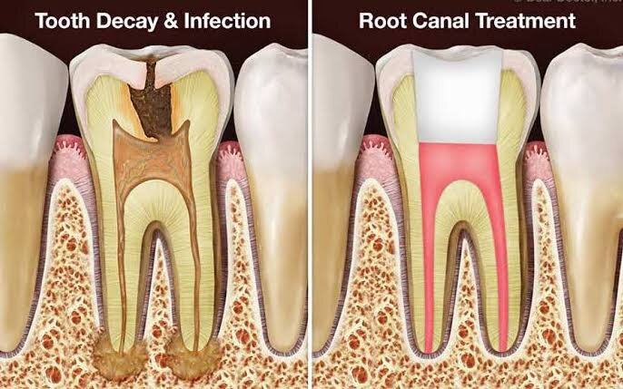The Journey to a Pain-Free Smile: How RCT Transformed Meera’s Life