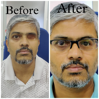 Restoring Confidence: How Silicon Orbital Facial Prosthetics Change Lives
