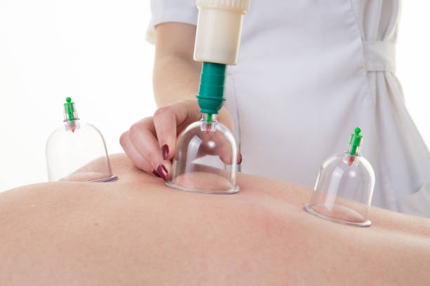 Unlocking Wellness: How Cupping Therapy Transformed Anita's Life