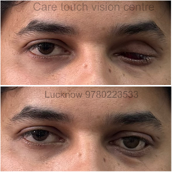 Embracing Confidence: Meera's Journey to Rediscovering Herself with an Artificial Eye