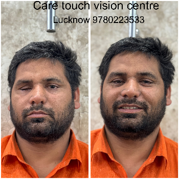 Custom Artificial Eye Prosthetic - Natural Look - Image 1