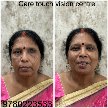 Custom Artificial Eye Prosthetic - Natural Look - Image 2