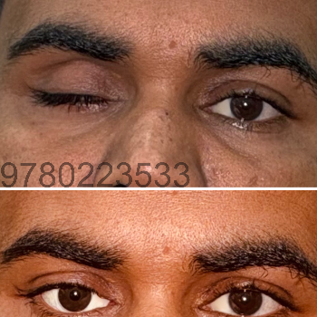 Custom Artificial Eye Prosthetic - Natural Look - Image 3
