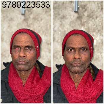 Custom Artificial Eye Prosthetic - Natural Look - Image 4