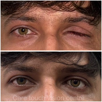 Custom Artificial Eye Prosthetic - Natural Look - Image 6
