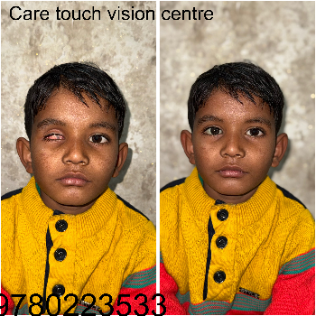 Custom Artificial Eye Prosthetic - Natural Look - Image 7
