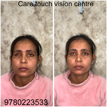 Custom Artificial Eye Prosthetic - Natural Look - Image 8