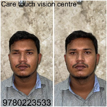 Custom Artificial Eye Prosthetic - Natural Look - Image 10