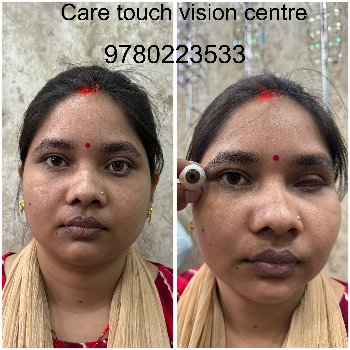 Custom Artificial Eye Prosthetic - Natural Look - Image 11