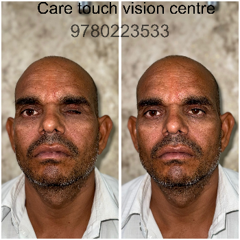 Custom Artificial Eye Prosthetic - Natural Look - Image 12