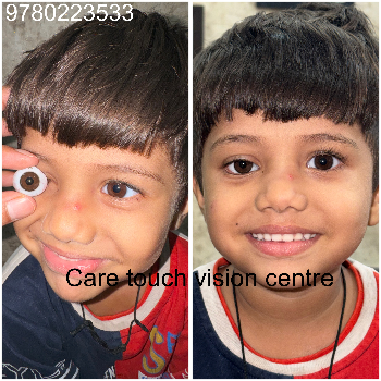 Custom Artificial Eye Prosthetic - Natural Look - Image 13