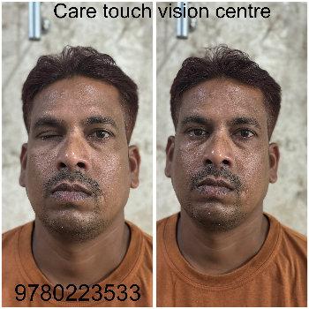 Custom Artificial Eye Prosthetic - Natural Look - Image 14