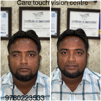 Custom Artificial Eye Prosthetic - Natural Look - Image 16
