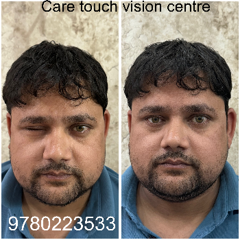 Custom Artificial Eye Prosthetic - Natural Look - Image 17