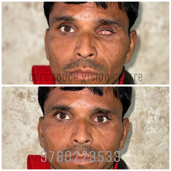 Custom Artificial Eye Prosthetic - Natural Look - Image 18