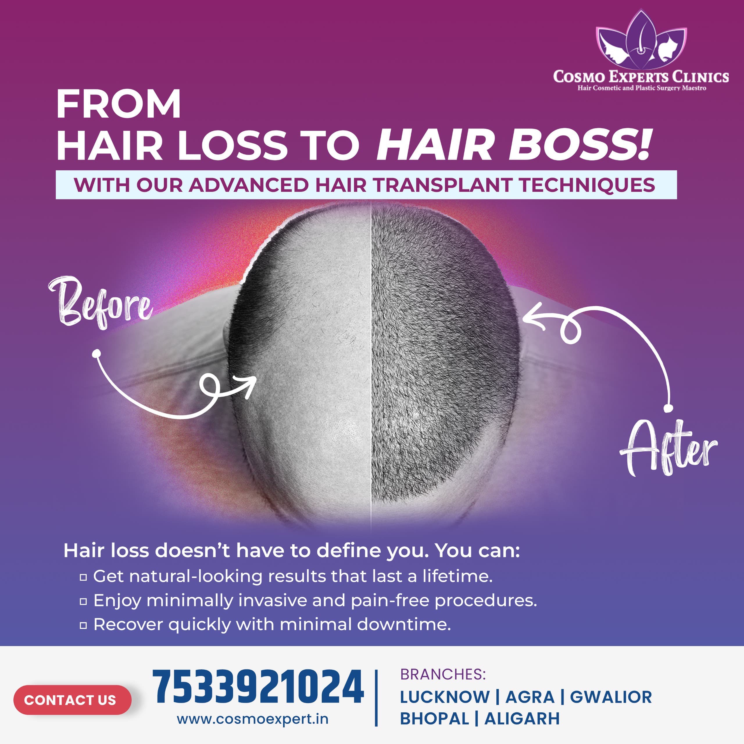 Advanced hair transplant techniques provided by COSMO EXPERTS CLINICS in Agra, demonstrating natural-looking hair restoration - Image 1