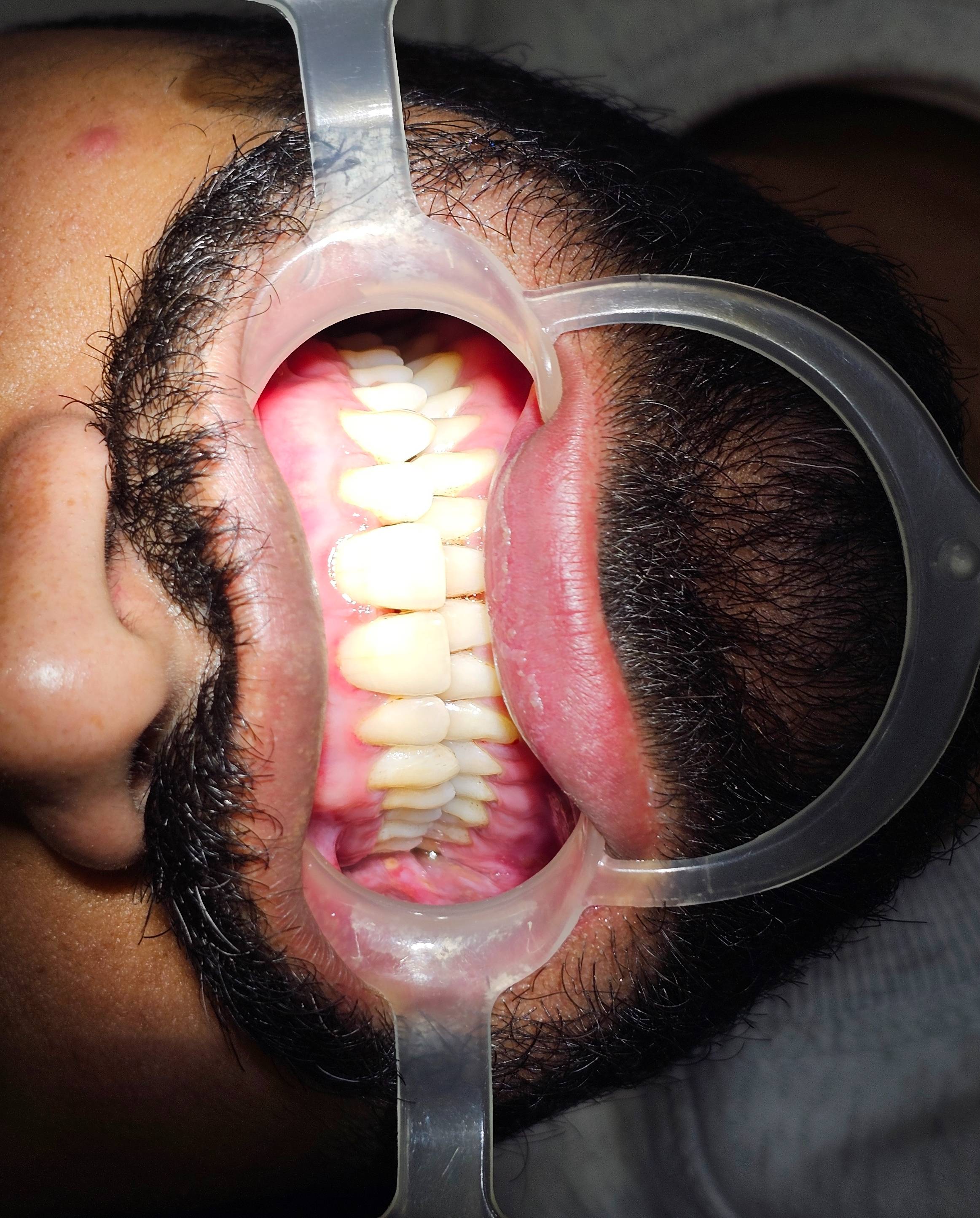 Teeth scaling procedure at PRODENT DENTAL AND IMPLANT CLINIC, Indore — effective cleaning for improved oral health