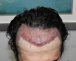 Hair transplant procedure showcasing a patient receiving treatment at Cosmo Experts Clinics in Agra, highlighting a natural h