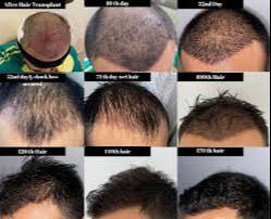Hair transplant procedure showcasing a patient receiving treatment at Cosmo Experts Clinics in Agra, highlighting a natural h - Image 1