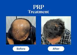  Hair Restoration PRP Treatment in Agra COSMO EXPERTS CLINICS PRIVATE LIMITED 2ND FLOOR SHANTIMADHUBAN PLAZAINFRONT OF RAVI HOSPITAL DELHI GATE AGRA 282002