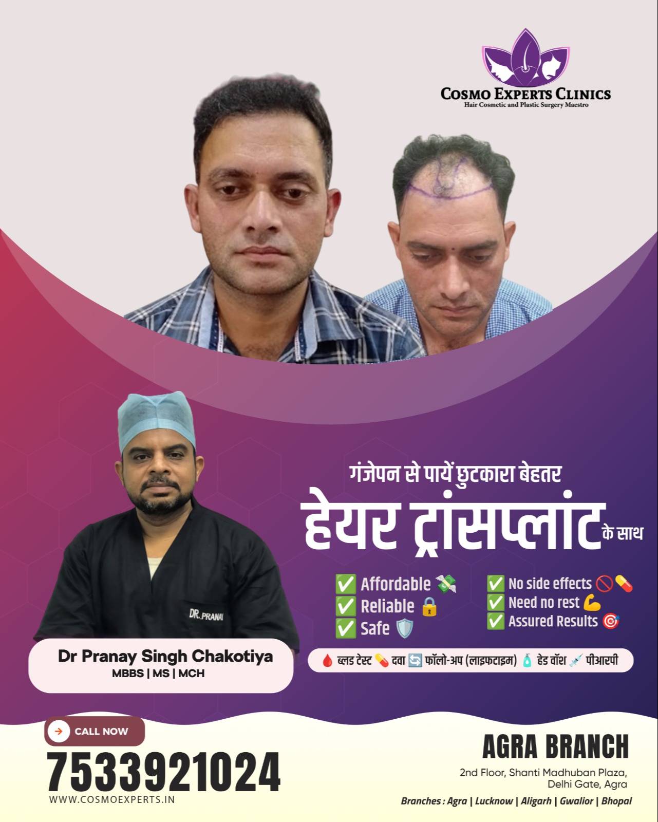  Hair Transplant Procedure in Agra COSMO EXPERTS CLINICS PRIVATE LIMITED 2ND FLOOR SHANTIMADHUBAN PLAZAINFRONT OF RAVI HOSPITAL DELHI GATE AGRA 282002
