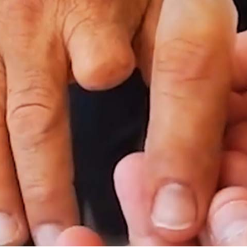 Silicon Finger Prosthesis in Lucknow — CARE TOUCH VISION