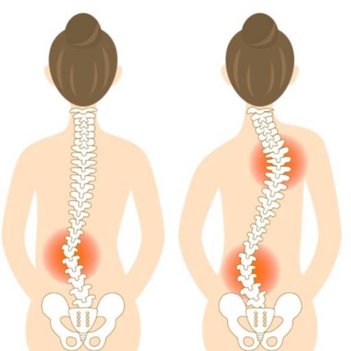 Scoliosis Deformity Correction in Derawal Nagar | Improve