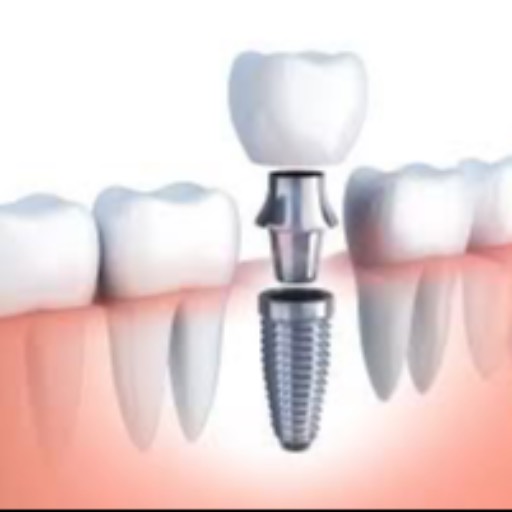 Dental Implants — Asha Dental Care, Kopar Khairane in NAVI