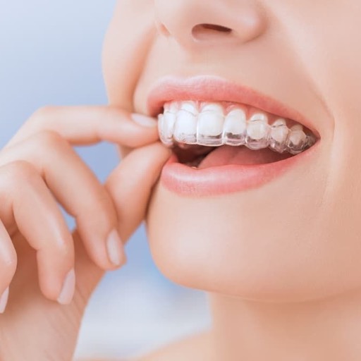 Clear Invisible Aligners — Asha Dentals Care, Kopar