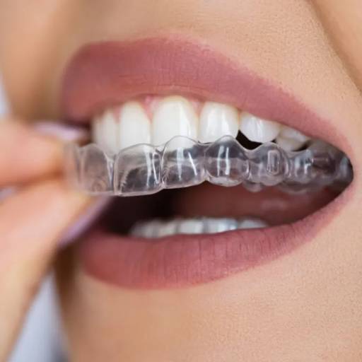 ORO DENTAL CLINIC - Aligners in Oro Dental Clinic | Discreet Teeth in JAHANGIRPURI