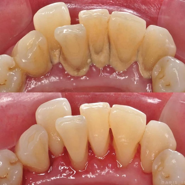 MODERN ORAL AND DENTAL CLINIC - Scaling and Polishing in Bikramganj — MODERN ORAL AND in Bikramganj